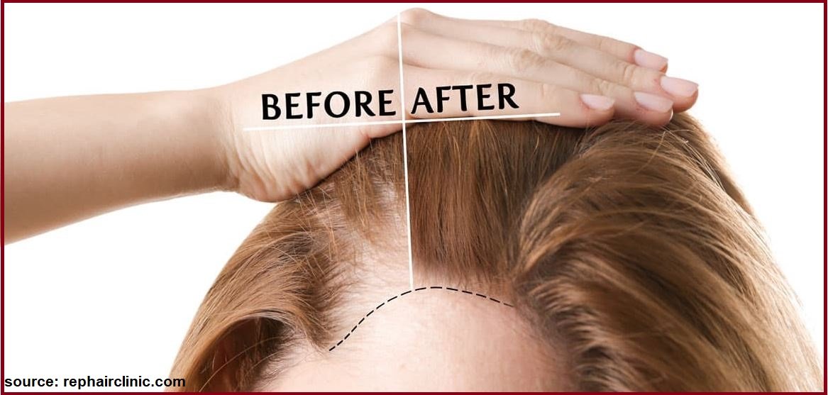 hair transplant for women in mumbai