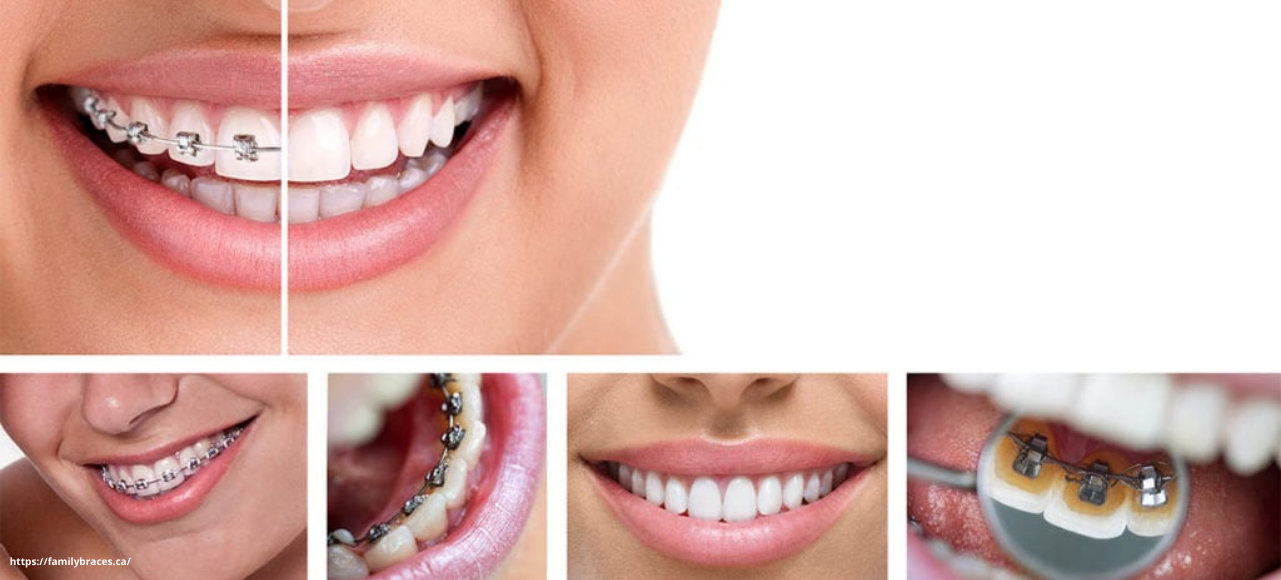 braces for adults braces for adults