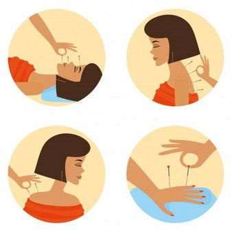 Acupuncture
