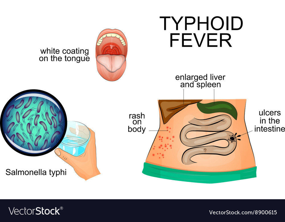 Typhoid Fever Treatment