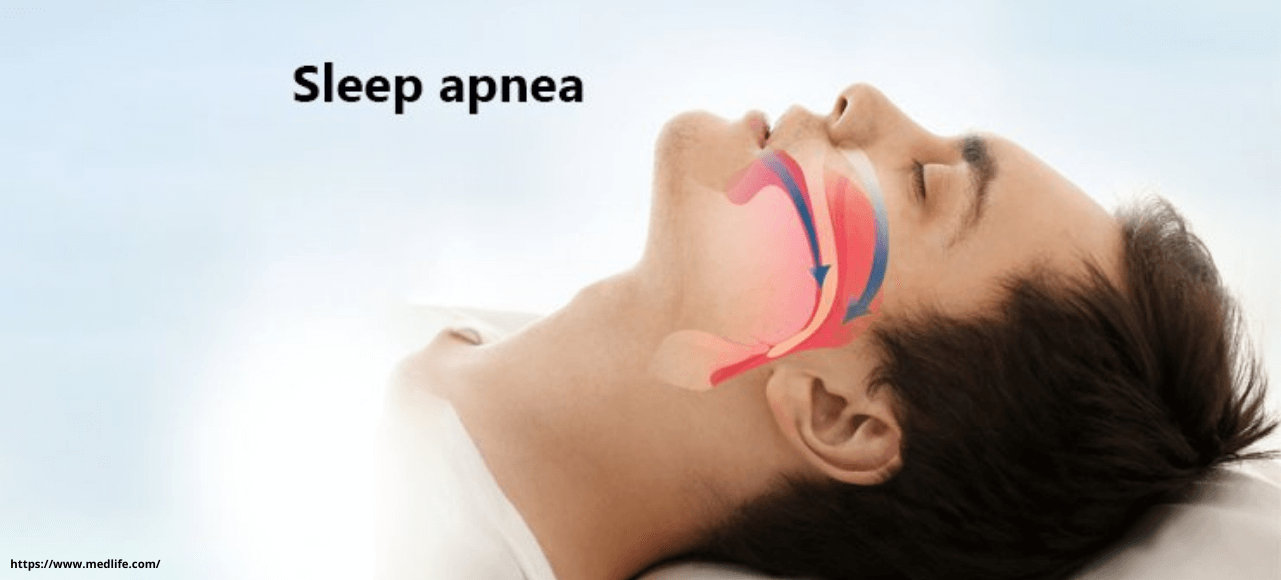 Sleep apnea Sleep apnea