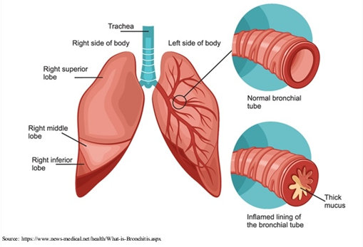 What is bronchitis