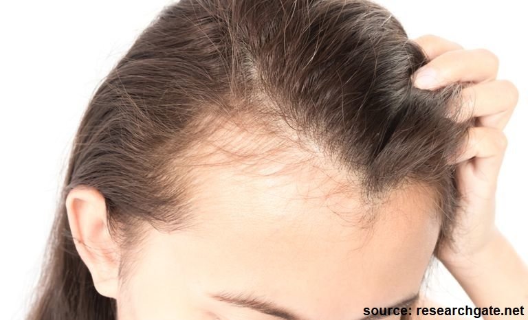 hair transplant for women