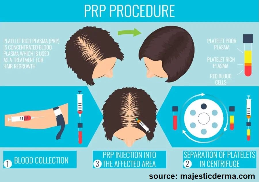 PRP therapy procedure