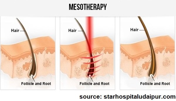 Mesotherapy For Hair