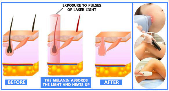 Laser Hair Removal