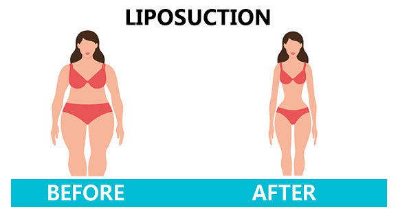 Liposuction
