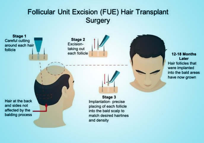 FUE hair transplant