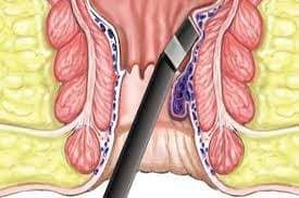 Laser piles treatment