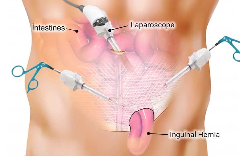 Laparoscopic hernia surgery