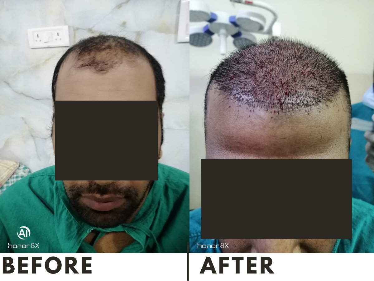 VIPFUE No Shave Long Hair Preview Hair Transplant  Bauman Medical