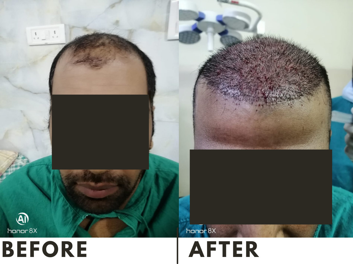Baldness Treated with a Combo of FUE & FUT Hair Transplant in Jaipur Baldness Treated with a Combo of FUE & FUT Hair Transplant in Jaipur