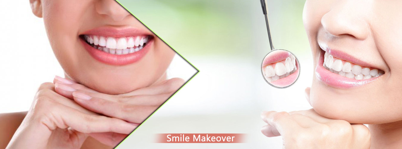 Smile Makeover Smile Makeover
