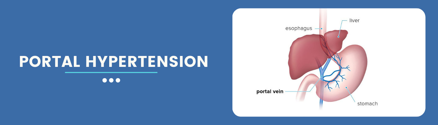 Portal Hypertension - Causes, Symptoms and Treatment Portal Hypertension - Causes, Symptoms and Treatment
