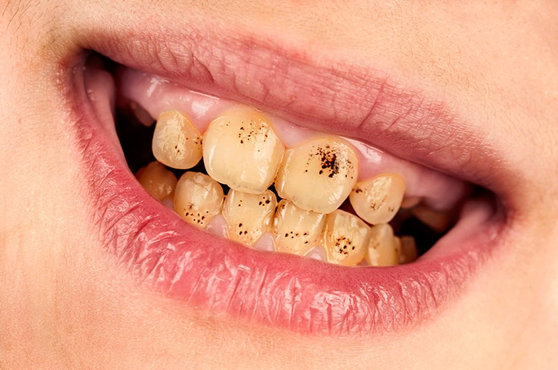 causes of stained teeth