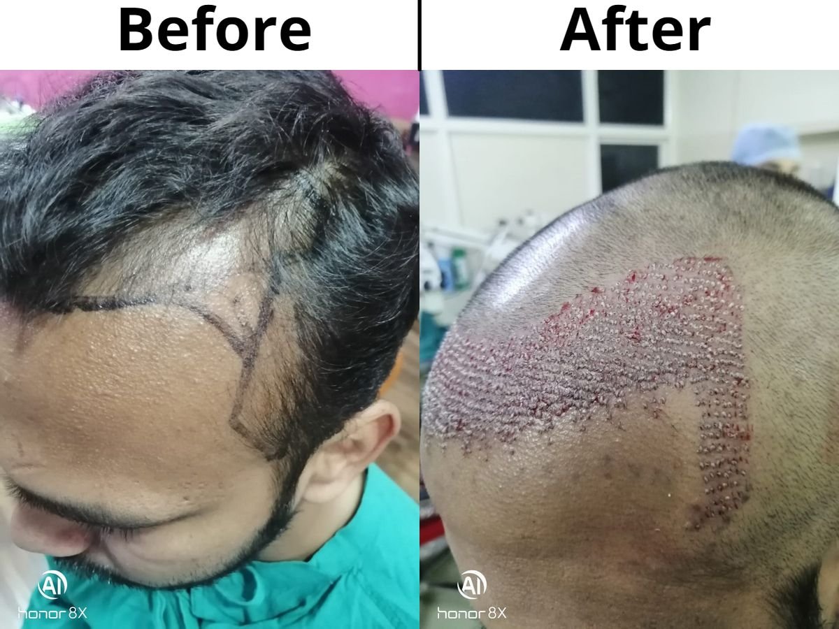 Hair Transplant in Jaipur Rajasthan  Best Hair Transplant Clinic