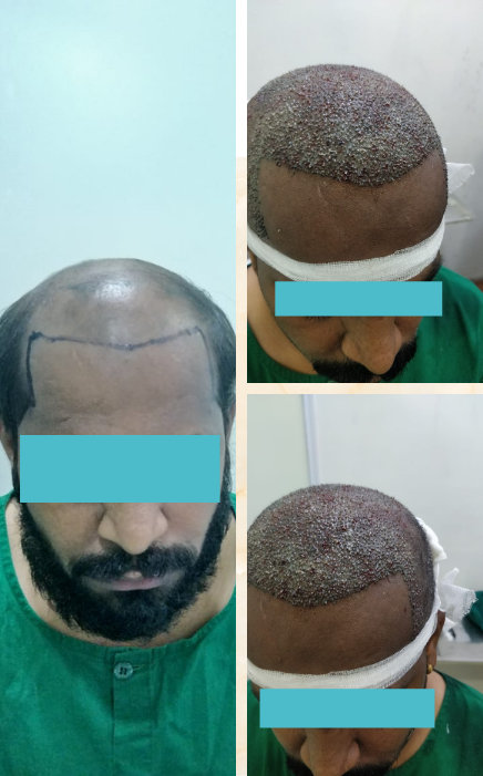 Cost of Hair Transplantation in India