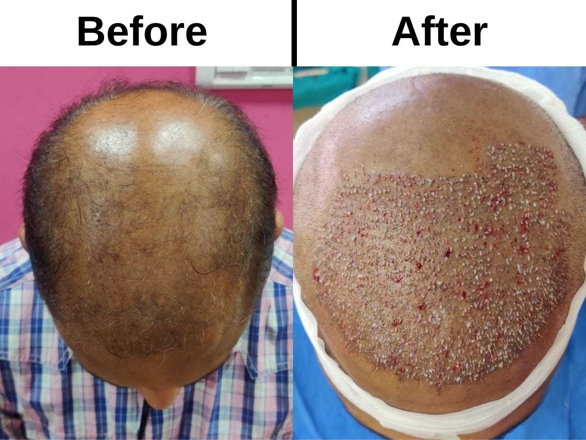 FUT plus FUE DHI hair transplant treatment in Jaipur to stage 7 baldness FUT plus FUE DHI hair transplant treatment in Jaipur to stage 7 baldness