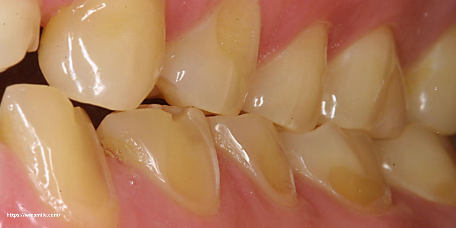 tooth's anatomy