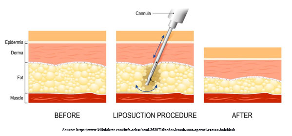How is Arm Liposuction Performed?