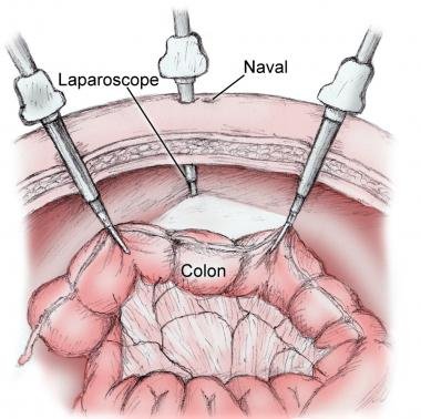 Laparoscopic Colectomy for Treating Colon Carcinoma
