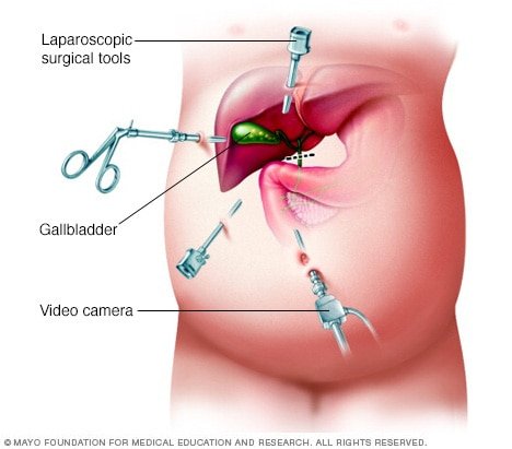 Laparoscopic cholecystectomy - Mayo Clinic