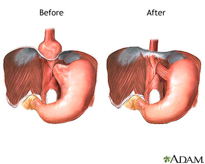 Hiatal hernia repair - series—Aftercare: MedlinePlus Medical Encyclopedia