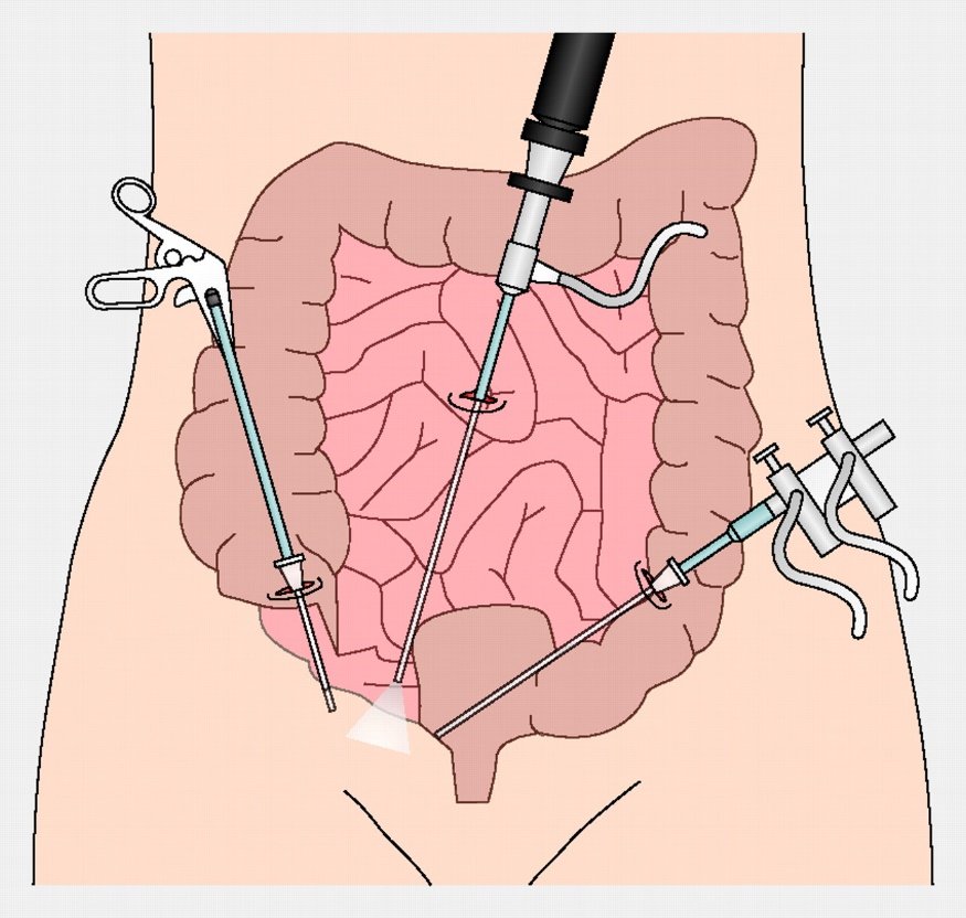 Laparoscopic colorectal surgery | The BMJ