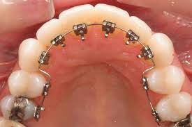 Lingual Orthodontics - Home | Facebook