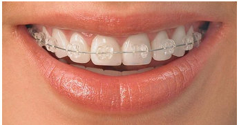 Ceramic Braces Treatment Services in Navi Mumbai, Sector 14, Koparkhairane by City Smiles Dental Cosmetics And Implant Clinic | ID: 16429018791