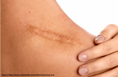 What is the Purpose of Scar Revision Surgery?