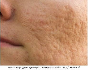 Facial scars are ugly and might limit facial expressions.