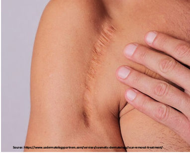 Long or irregular scars resulting from injuries or previous surgery. 