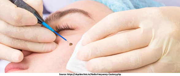 Radio Cautery