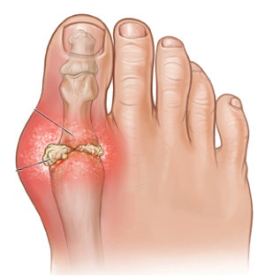 What is Gout?