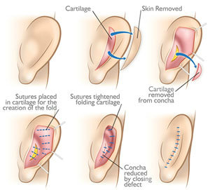 Ear Surgery San Diego | Otoplasty La Jolla CA| Feel Beautiful