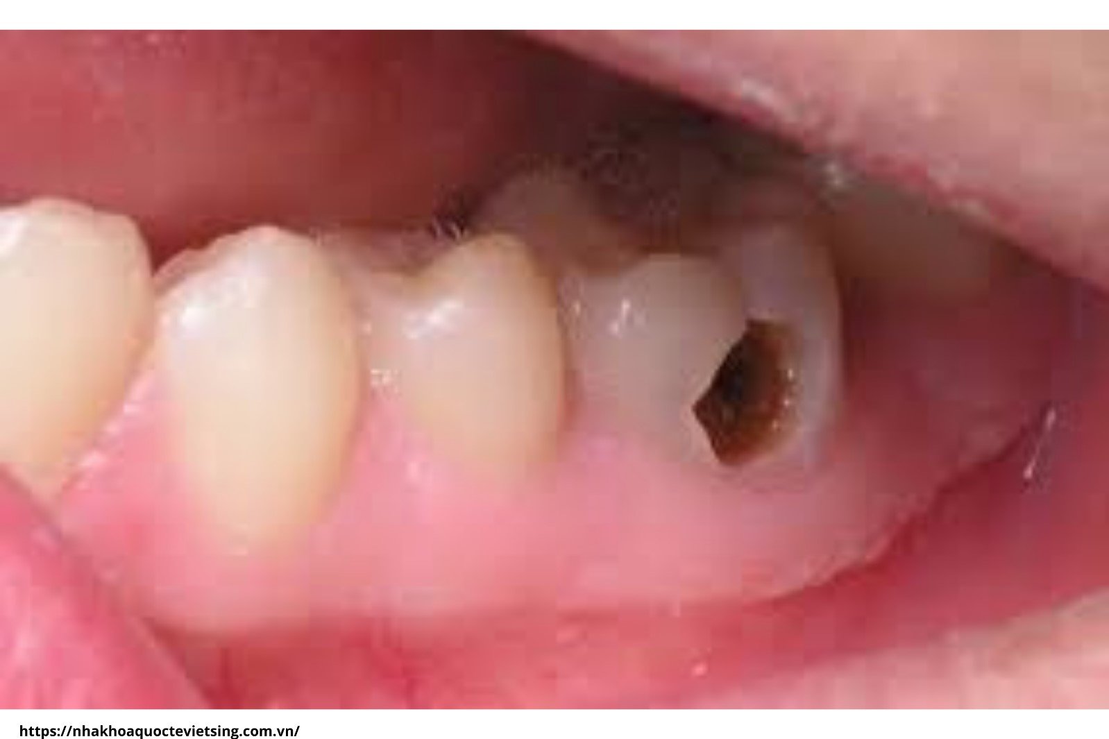 Dental Decay Treatment