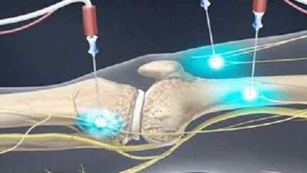 genicular nerve radiofrequency