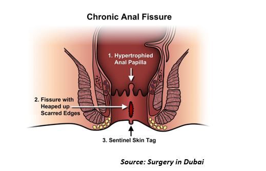 chronic anal fissure