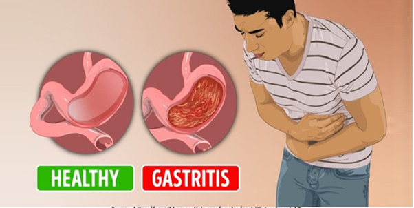 Gastritis Gastritis