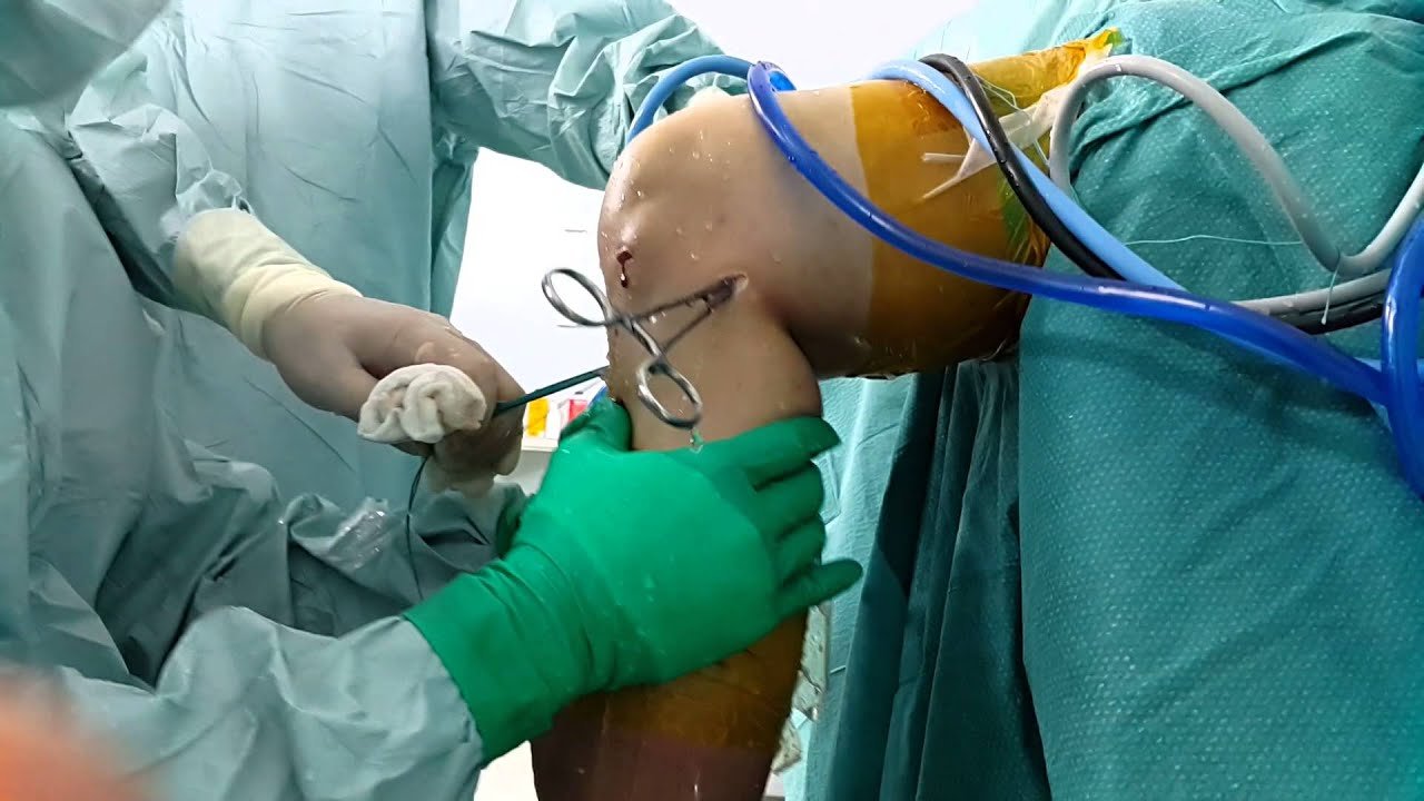 PCL surgery and how does it work