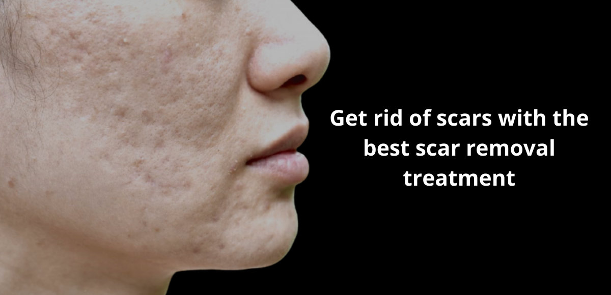 scar treatment scar treatment
