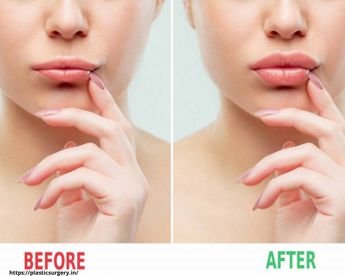 Lip surgery