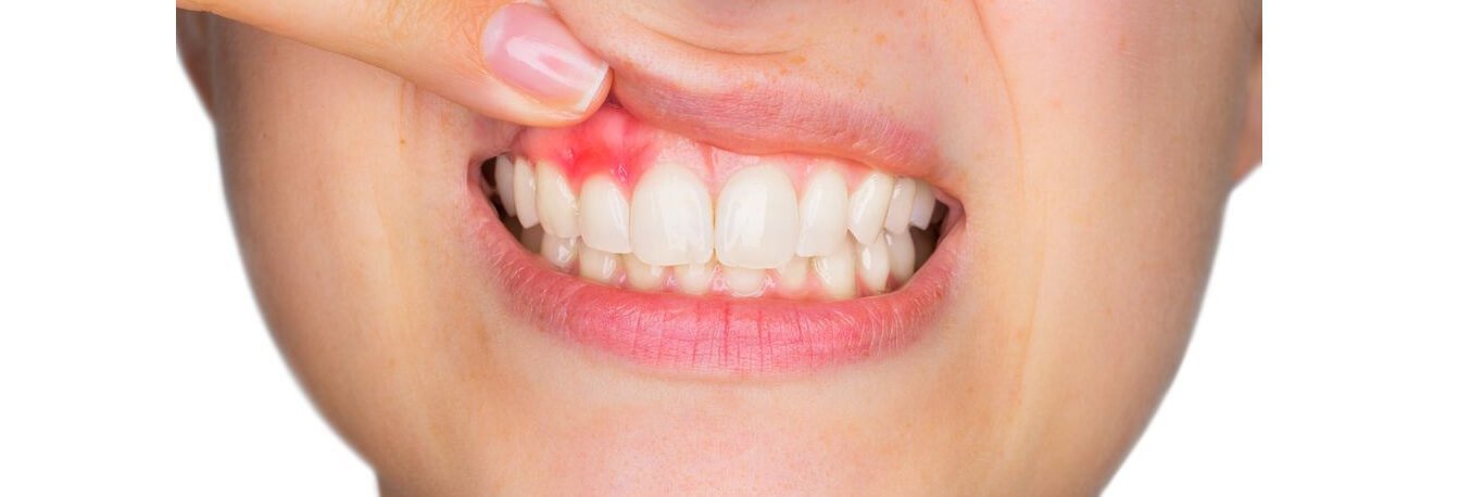 How to treat bleeding gums? How to treat bleeding gums?