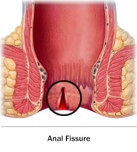 Fissure Treatment, Clinic | Surgeon | Laser Surgery