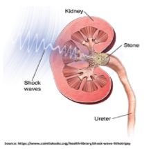 Shockwave lithotripsy