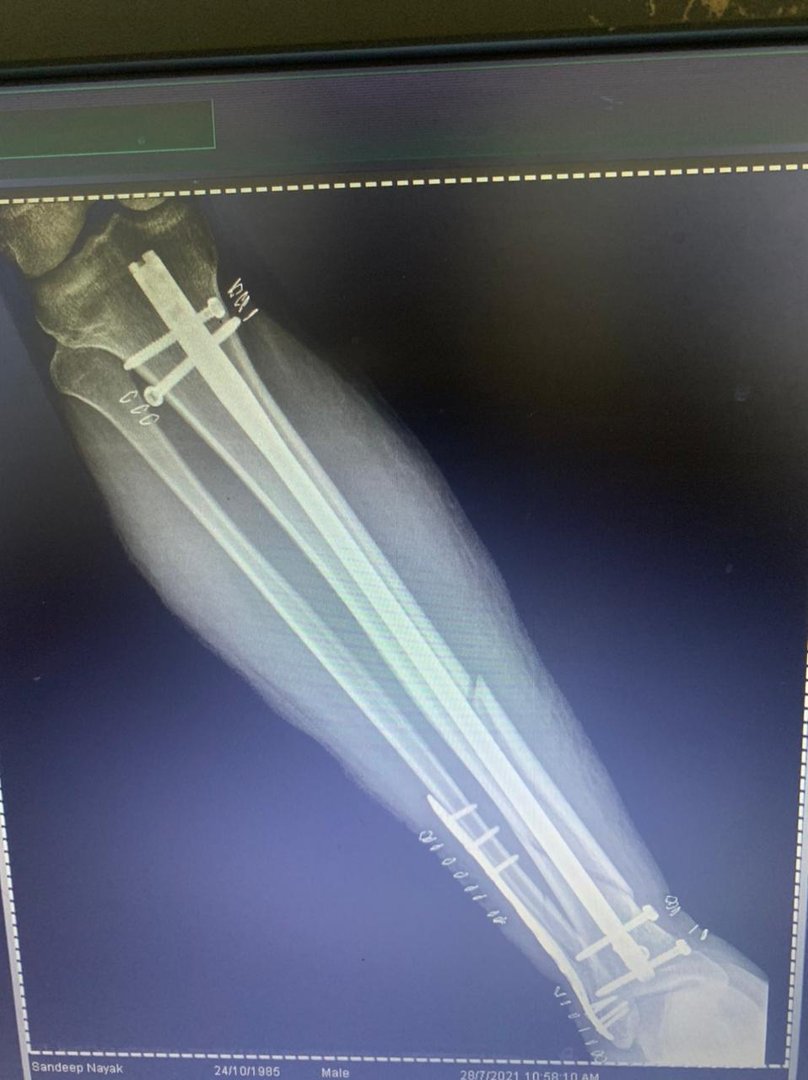 bone-fracture-treatment-in-bhubaneswar