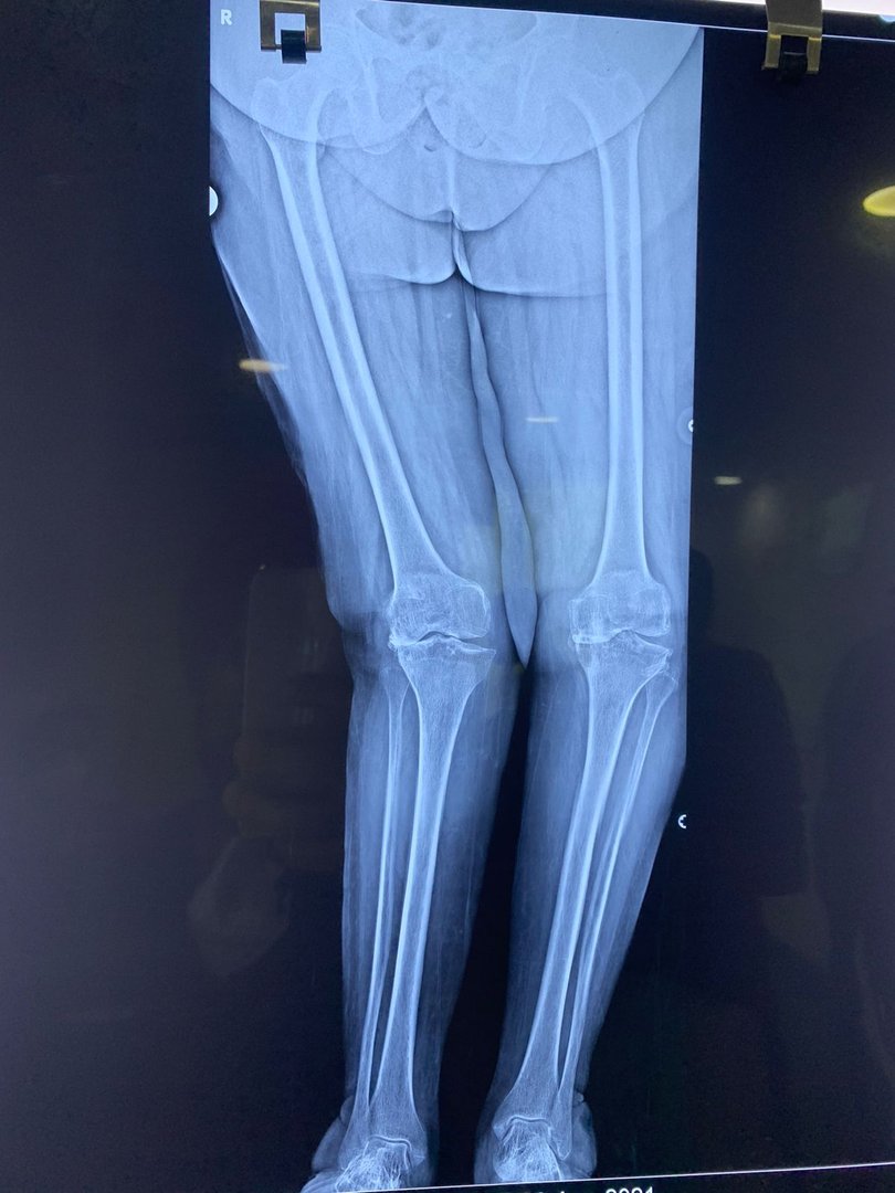Knee deformity