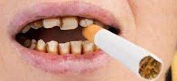 Negative effects of smoking in teeth Negative effects of smoking in teeth