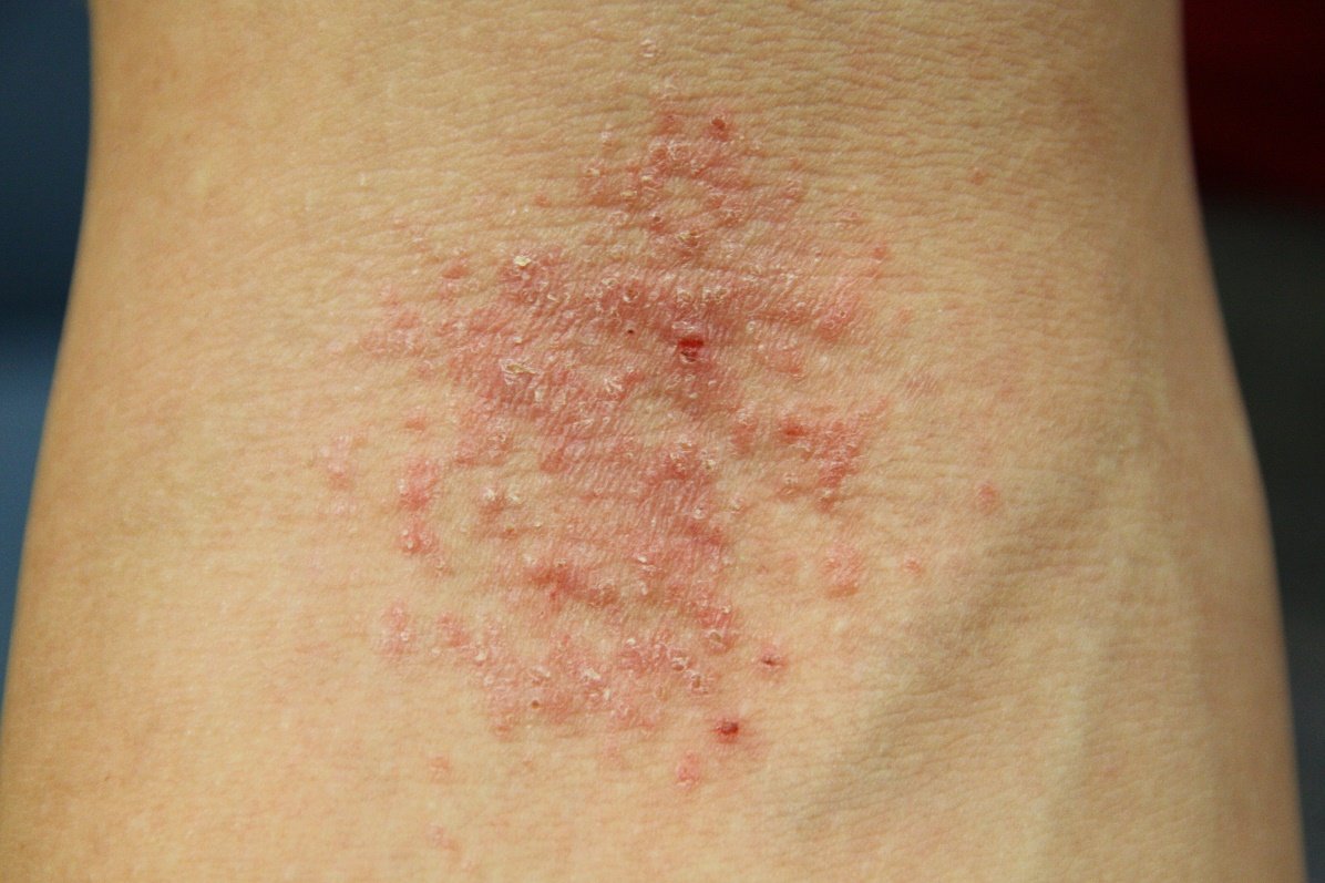 A close-up of a person's skin
Description automatically generated with low confidence